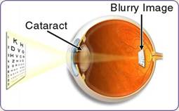 Cataract surgery